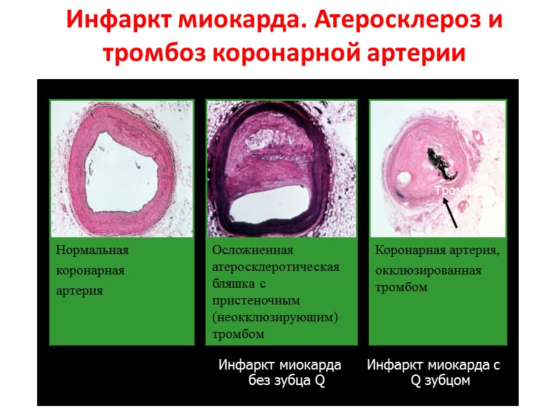 Инфаркт миокарда. Атеросклероз и тромбоз коронарной артерии Тромб Инфаркт миокарда без зубца Q Инфаркт